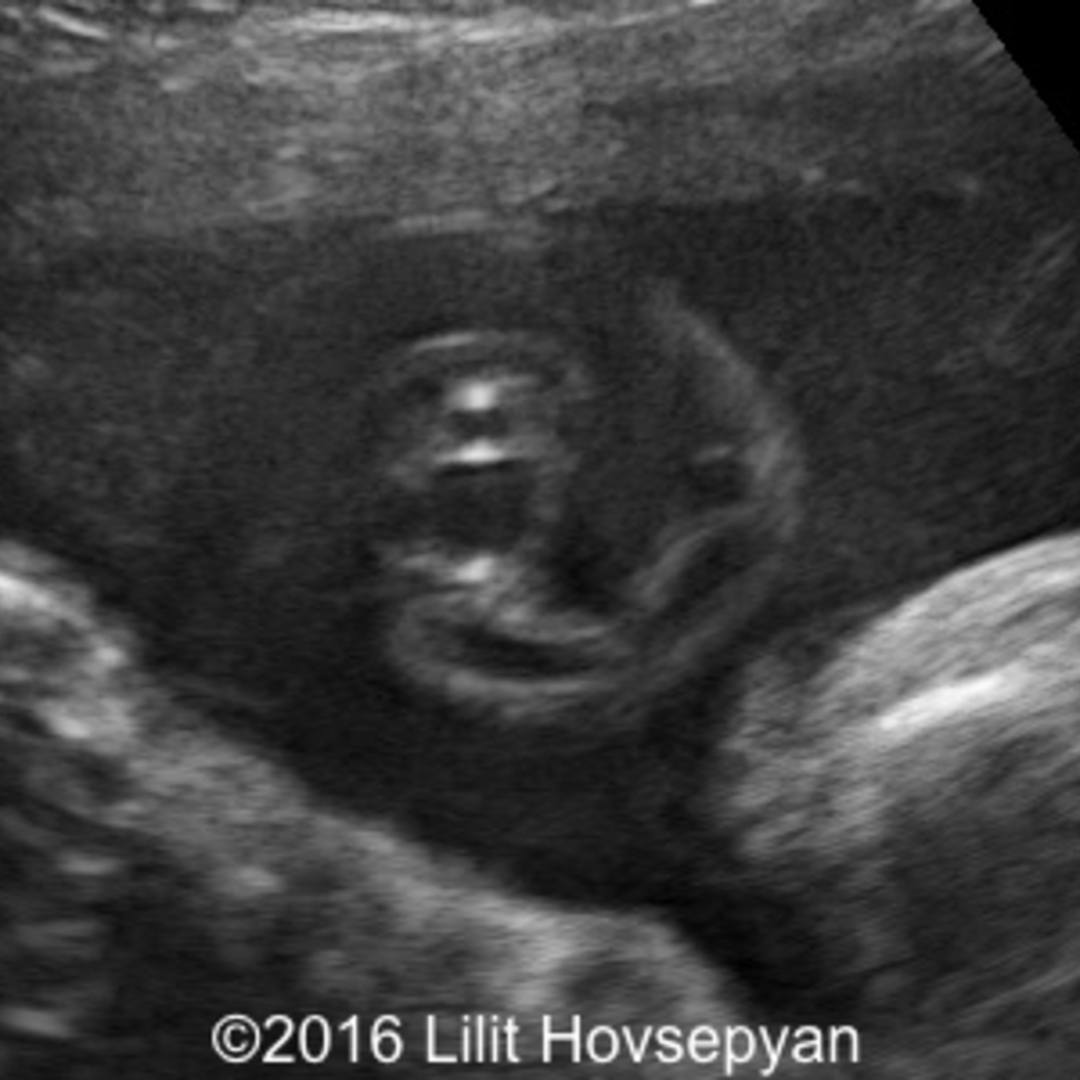  true knot of the umbilical cord