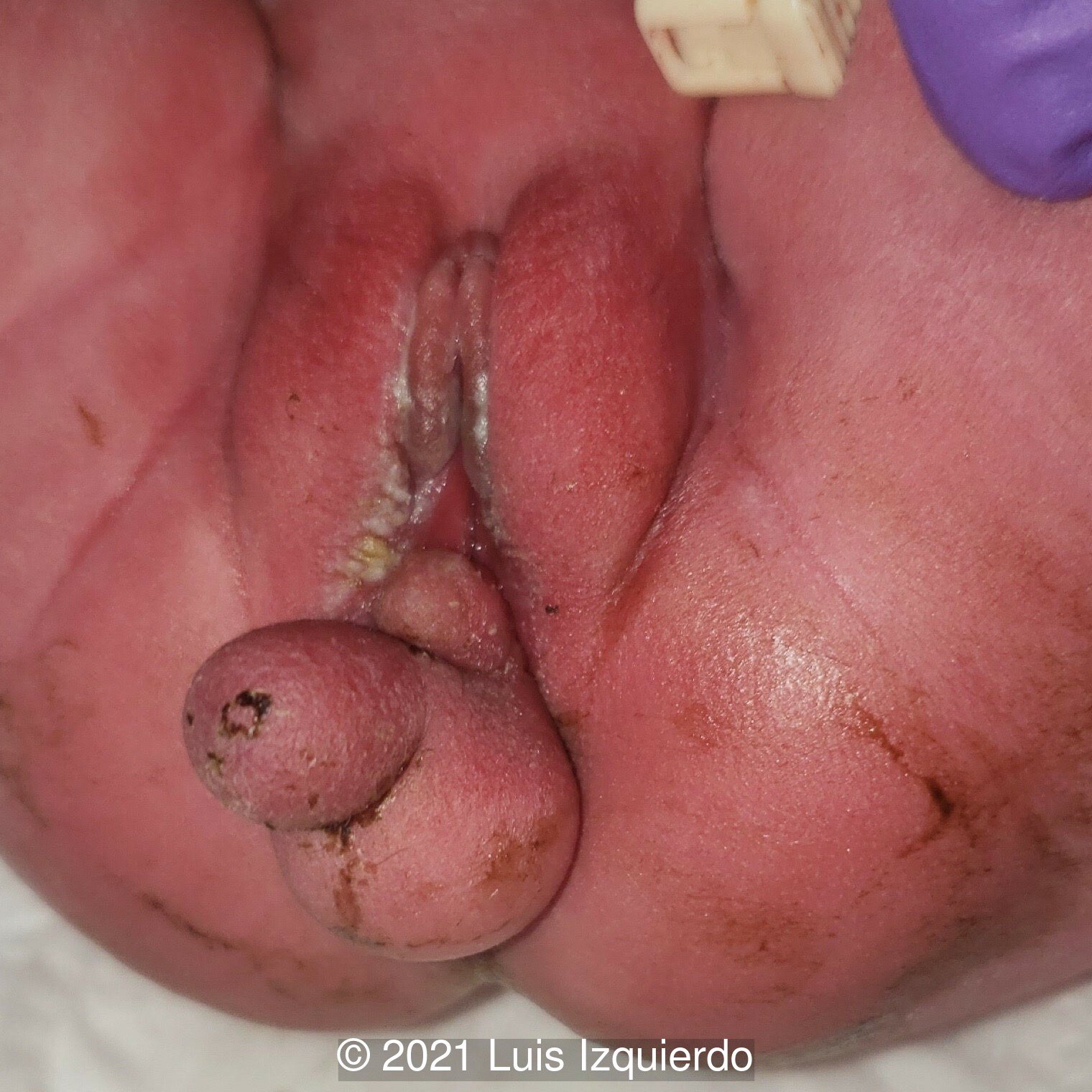 Pre-operative image of the perineal mass.