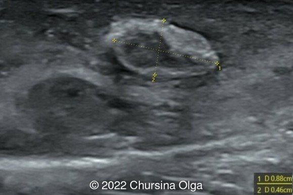 Normal structure of the contralateral right testicle of a newborn