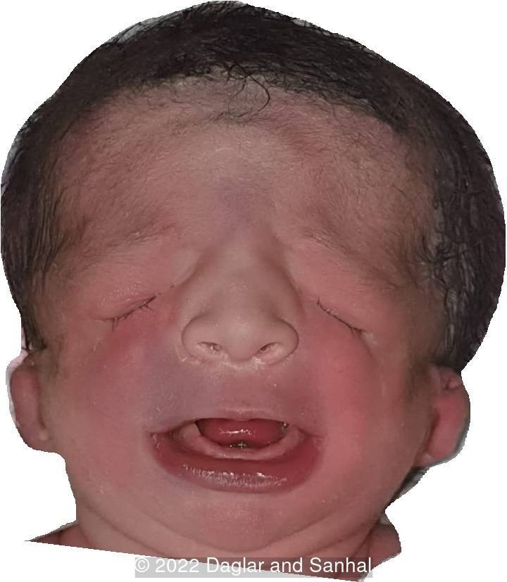 Typical features of Treacher Collins Syndrome including downslanting palpebral fissures, zygomatic arch and malar hypoplasia, malformed pinnas, small mandible and relative macrostomia.