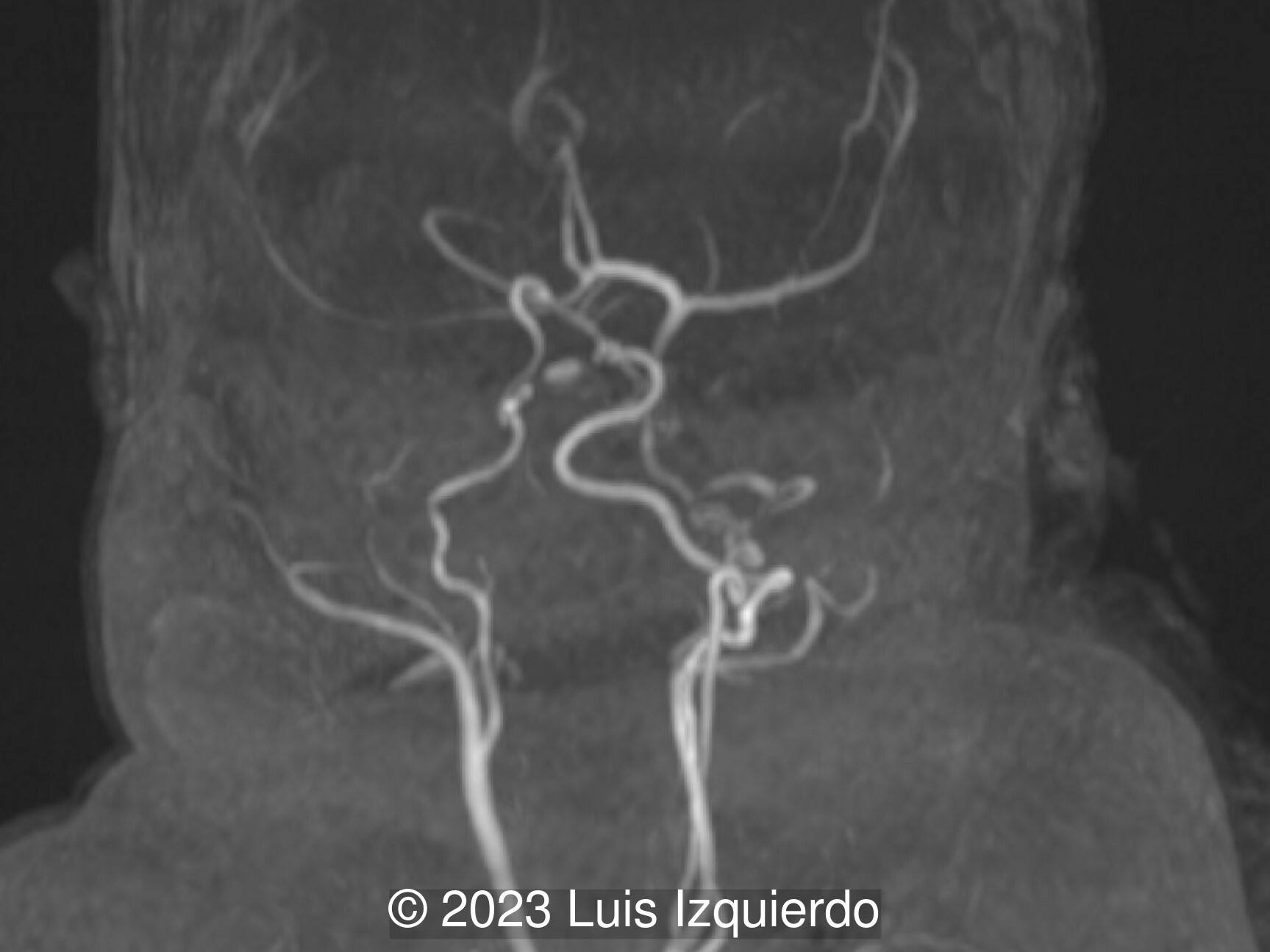 Postnatal MR angiogram.