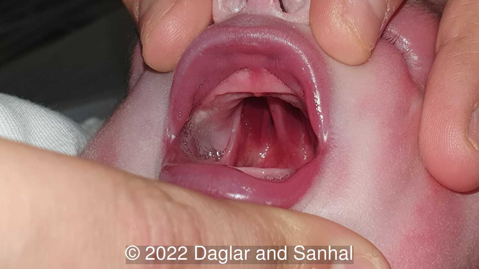 Midline cleft of the hard and soft palate with intact premaxilla.