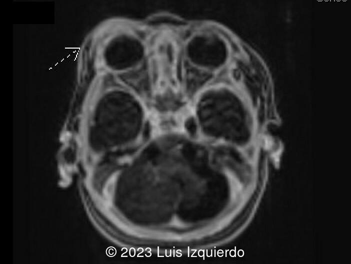 Postnatal MRI reveals enhancing, asymmetric ill-defined soft tissue lesion of the right peri/supraorbital soft tissues