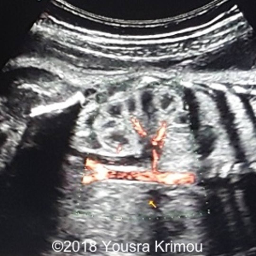 📃 Ectopic pelvic kidney