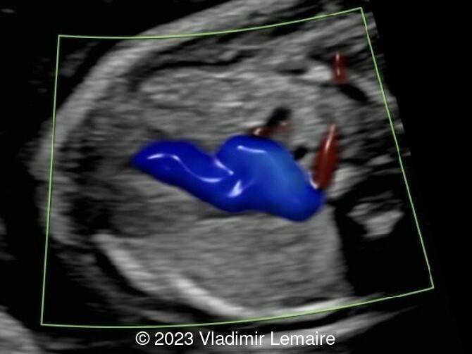 Aberrant right subclavian artery, seen in red, in a fetus at 20 weeks of gestation.