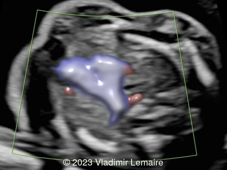 Aberrant right subclavian artery, seen in pink, in a fetus at 19 weeks of gestation.
