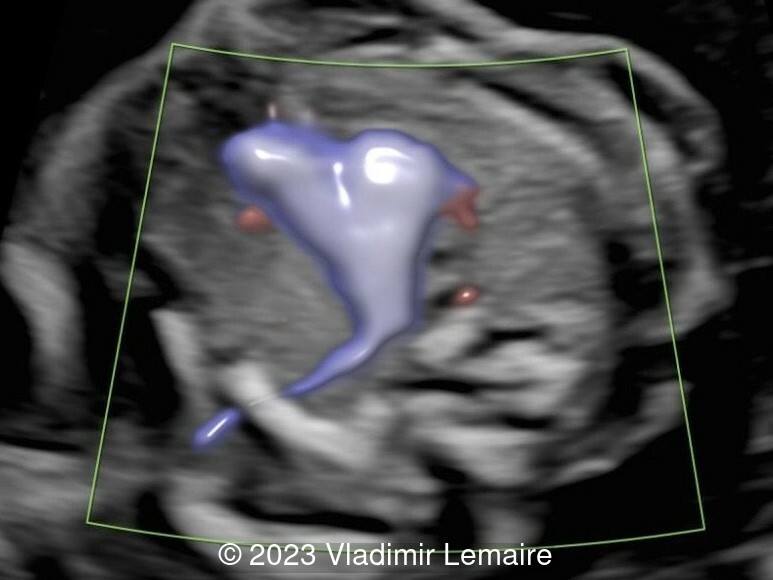 Left subclavian artery, in the same fetus, coursing toward the left arm.
