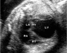 Aneurysm, left ventricle image