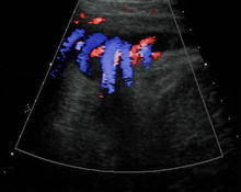 Ultrasound diagnosis of quintuple nuchal cord entanglement and fetal stress image