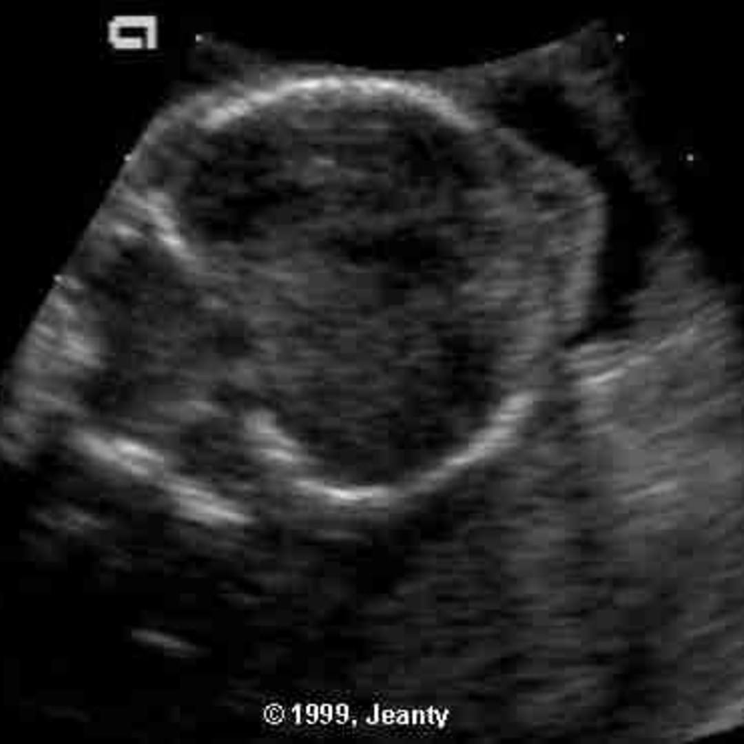 📃 WalkerWarburg syndrome