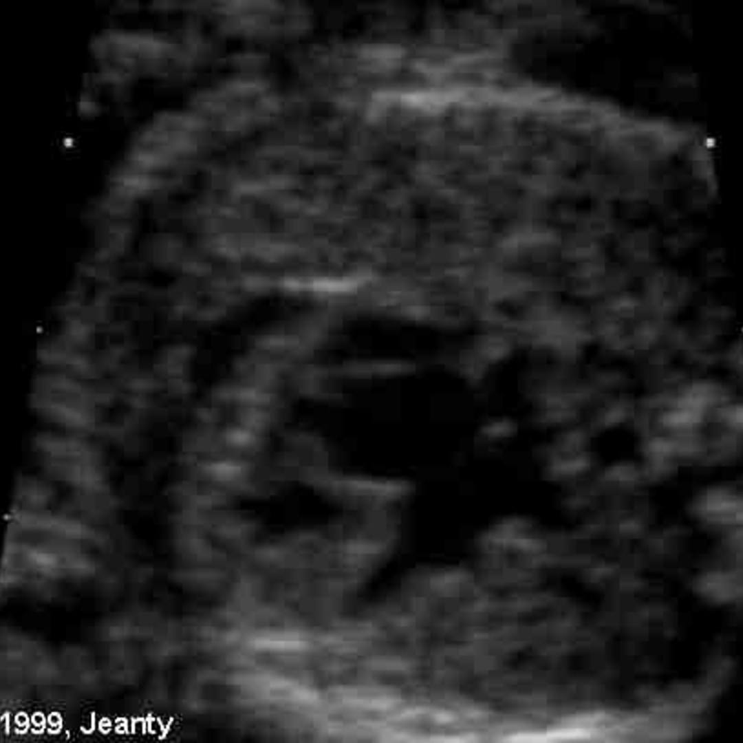 📃 Hypoplastic left heart syndrome