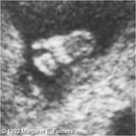 Second trimester ultrasound scan | Radiology Reference Article |  Radiopaedia.org