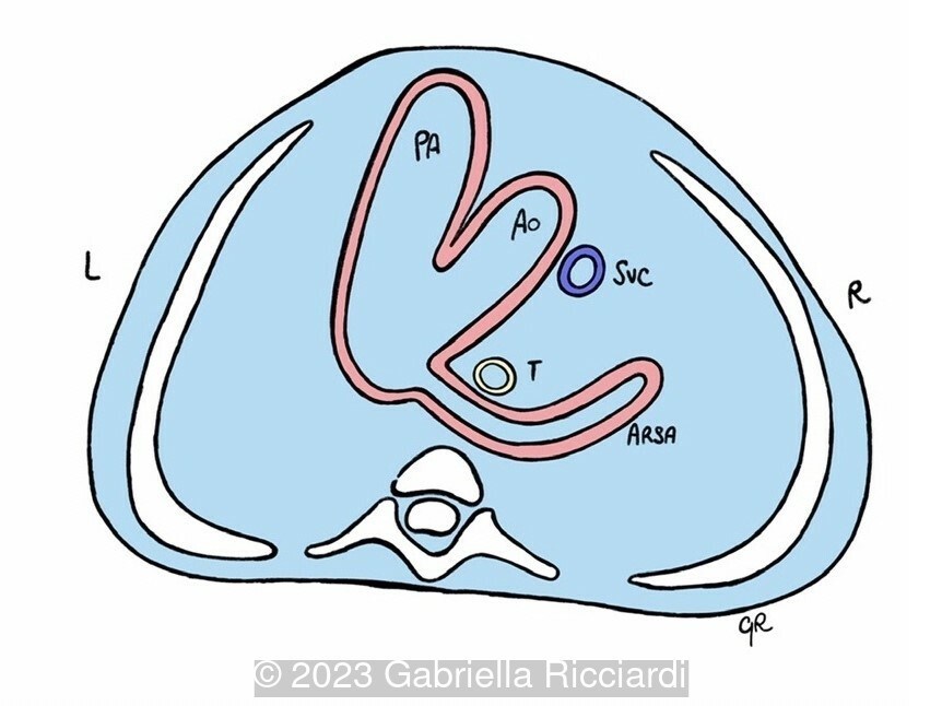Schematic drawing demonstrating the course of the ARSA, posterior to the trachea and esophagus and toward the right arm.
