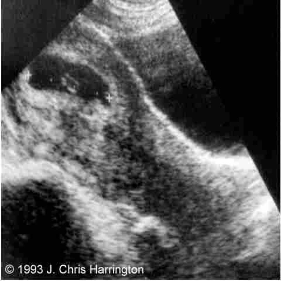 📃 Heterotopic Pregnancy 