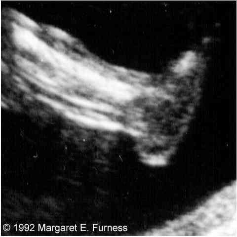 Calaméo - Ultrasound of Congenital Fetal Anomalies - Paladini