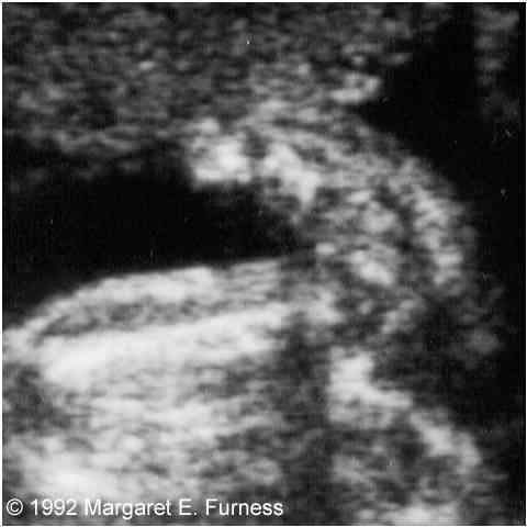 Ultrasound - missing toes | BabyCenter