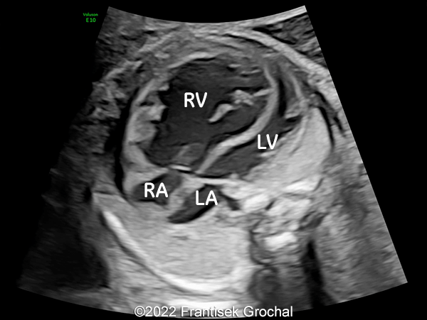 Four-chamber view of the heart (RV-right ventricle; LV-left ventricle; RA-right atrium; LA-left atrium)