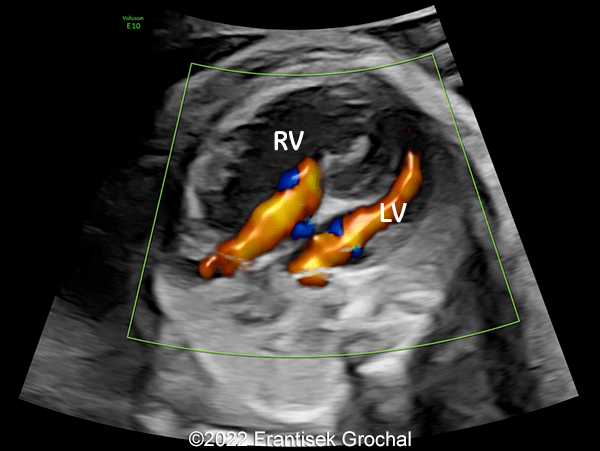 Color flow mapping demonstrating blood flow entering the ventricles in diastole (RV-right ventricle; LV-left ventricle)