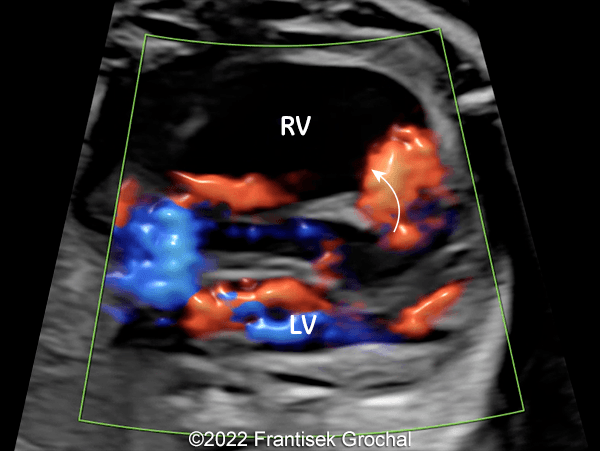 Color Doppler four-chamber view of the heart showing blood flow (red) out of the dissected cavity within the interventricular septum (curved arrow). (RV–right ventricle; LV–left ventricle)