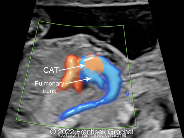 Sagittal color Doppler view of the heart showing Common Arterial Trunk (CAT) with Pulmonary trunk arising from dorsal part of the CAT.