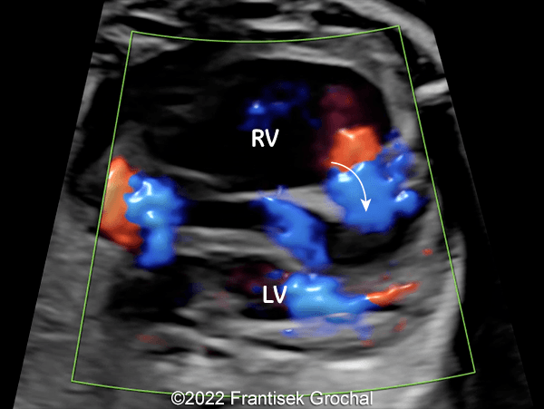 Color Doppler four-chamber view of the heart showing blood flow (blue) entering the cavity within the interventricular septum (curved arrow). (RV–right ventricle; LV–left ventricle)