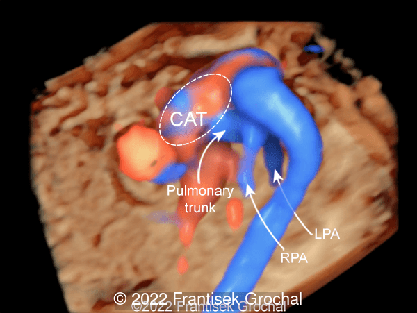 3D color Doppler view of the heart showing Common Arterial Trunk (CAT) with Pulmonary trunk arising from dorsal part of the CAT. RPA - Right Pulmonary Artery, LPA - Left Pulmonary Artery.