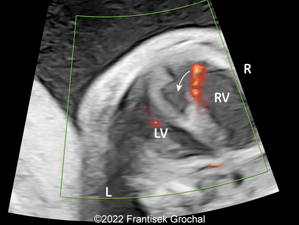 Four-chamber view showing an abnormal interventricular septum with separated left and right walls and central cavitation. A defect can be seen in its right wall (curved arrow) which enables the blood to enter and dissect the interventricular septum.