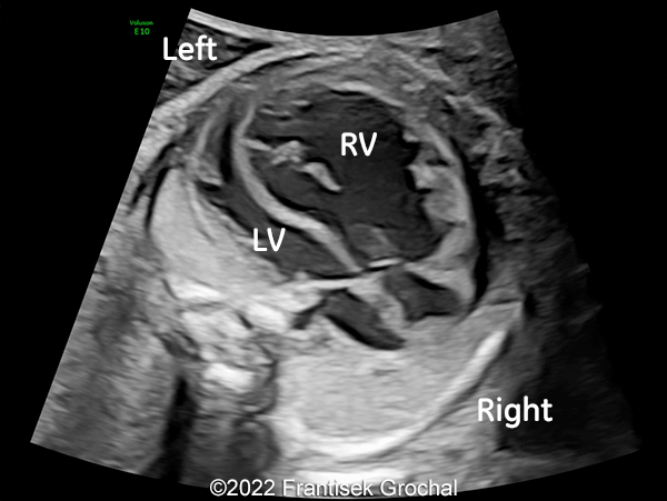 Four-chamber view of the heart (RV-right ventricle; LV-left ventricle)