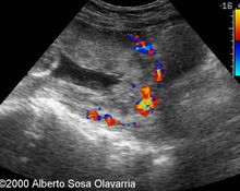 Placenta percreta image