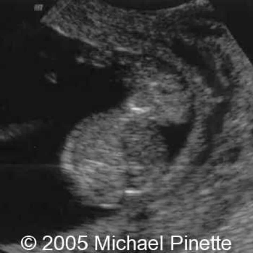 📃 Acardiac twin mimicking a gastroschisis