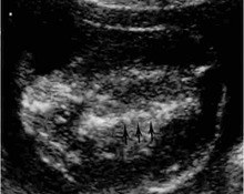 Twin reversed arterial perfusion (acardiac), amorphus image