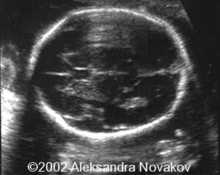 Ultrasound examination in the second and third trimester image