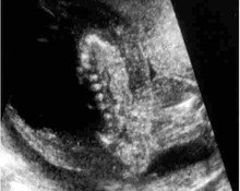 Twin, acardiac, ultrasound-guided embolization image