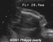 Congenital absence of fibula image