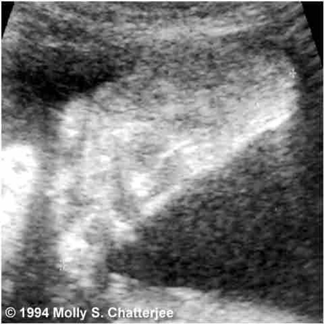 Assessment of Gestational Age by Ultrasound | GLOWM