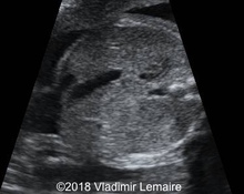 Persistent right umbilical vein image
