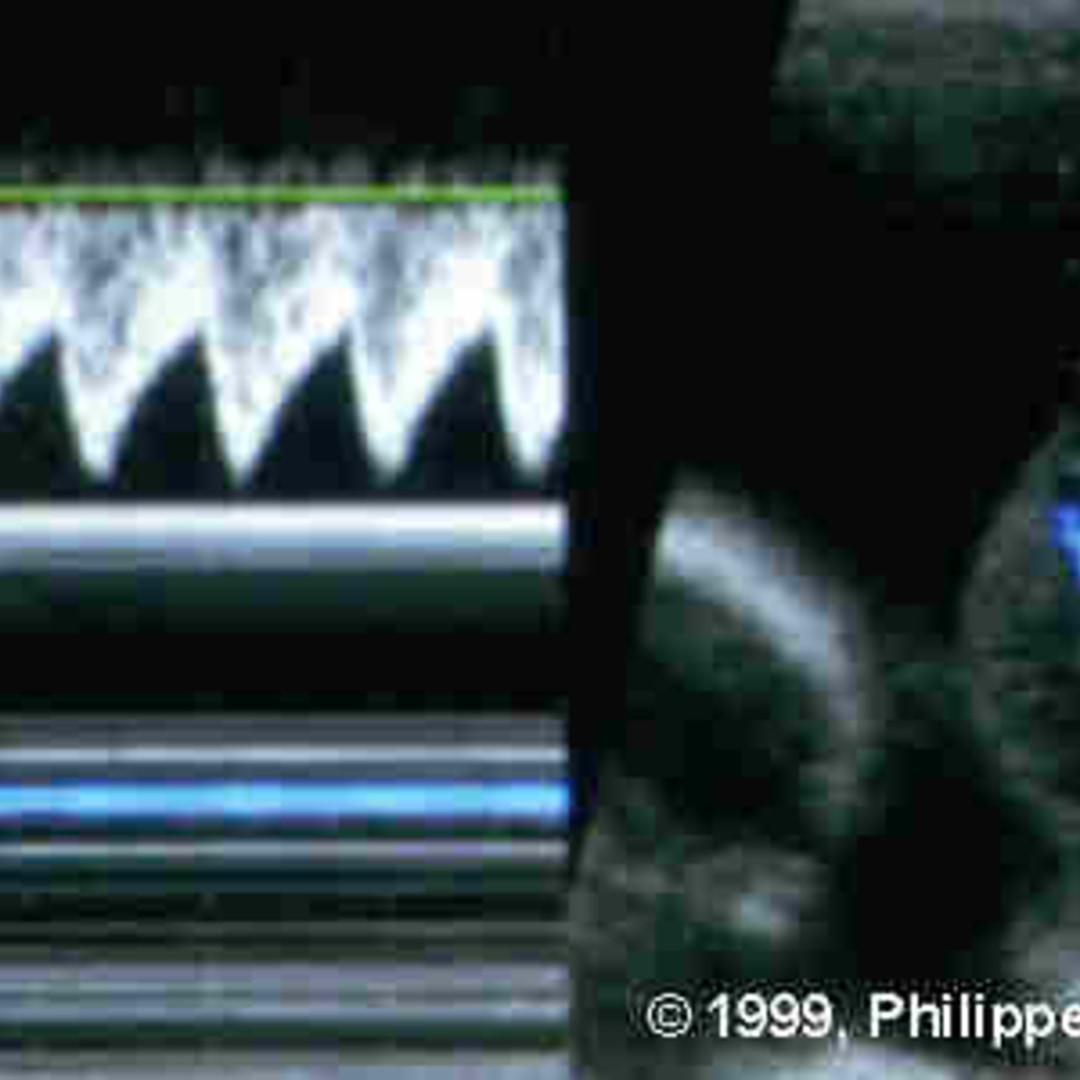 📃 Twinreversed arterial perfusion syndrome (TRAP or Acardiac twin)