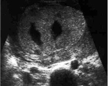 Trisomy 22, placenta image