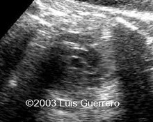 Pulmonary valve stenosis image