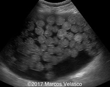 Mature ovarian teratoma image