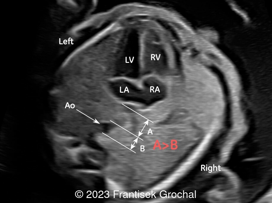 4-chamber view of the heart showing enlarged posterior left atrial space.