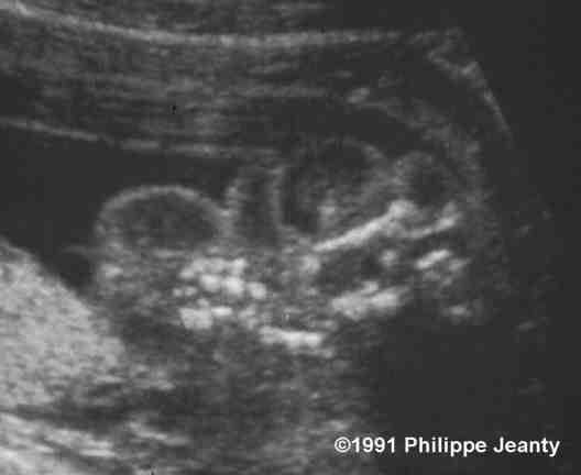 iniencephaly ultrasound