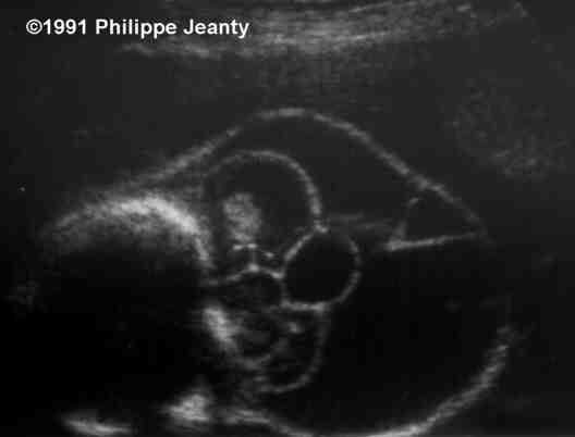 iniencephaly ultrasound