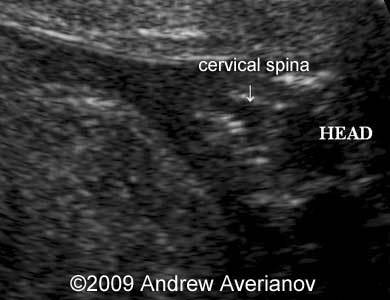 spina bifida 3d ultrasound