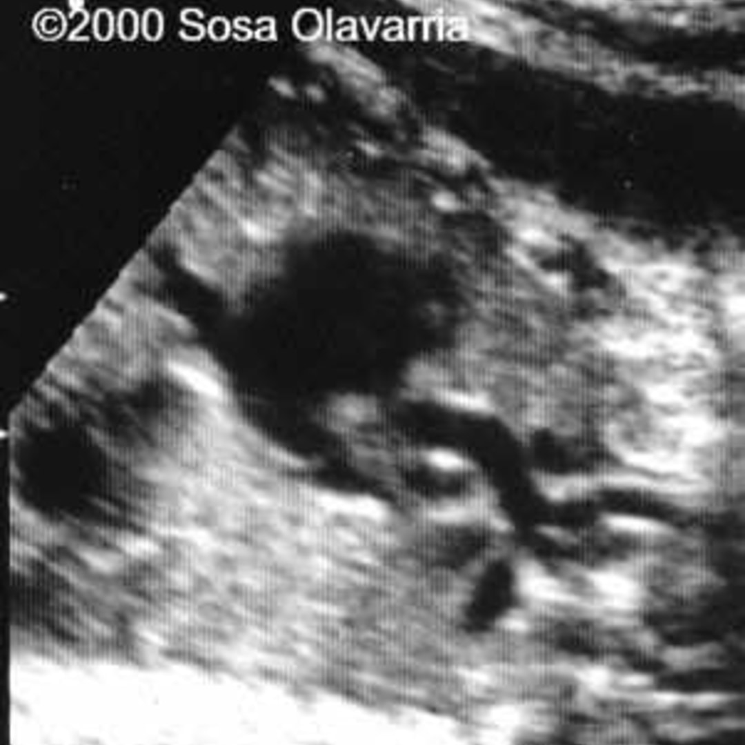 📃 Interrupted aortic arch with thymic hypoplasia syndrome