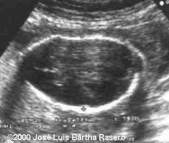 kidney3