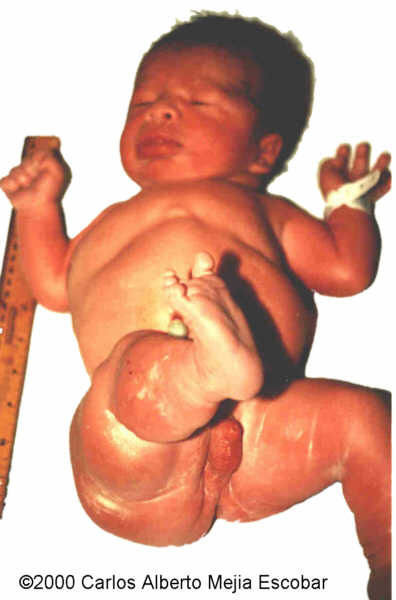 klipplel-trenaunay-weber-1-birth