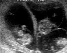 Invasive procedures in multifetal pregnancies image