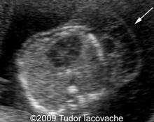Axillary lymphangioma image
