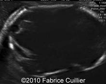 Meckel Gruber syndrome image